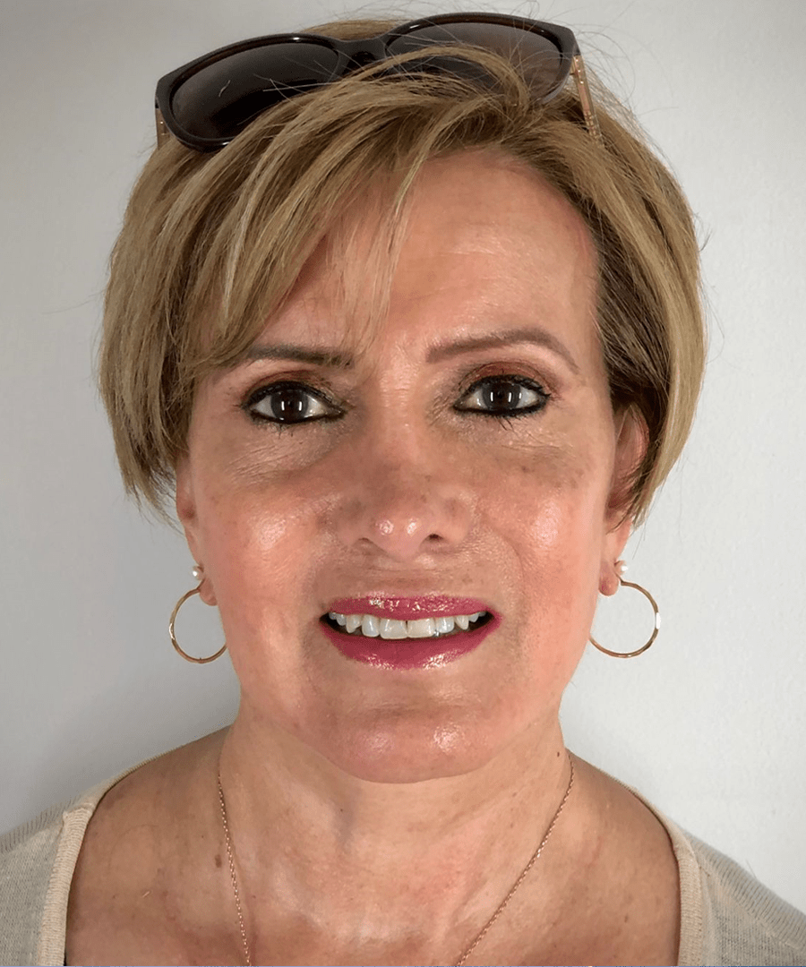Despues de lifting facial - caso 2