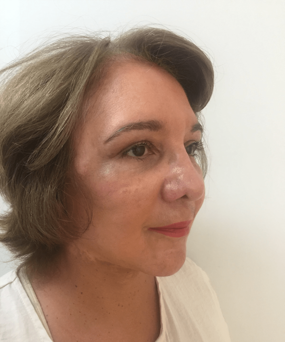 Despues de lifting facial - caso 3