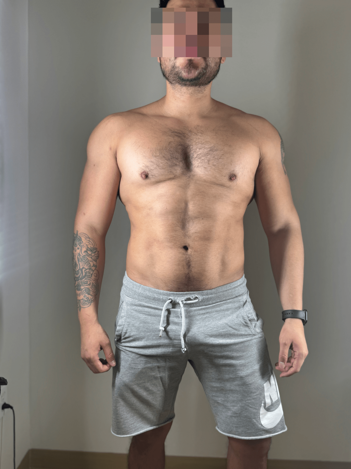 Despues de lipoescultura - caso 5