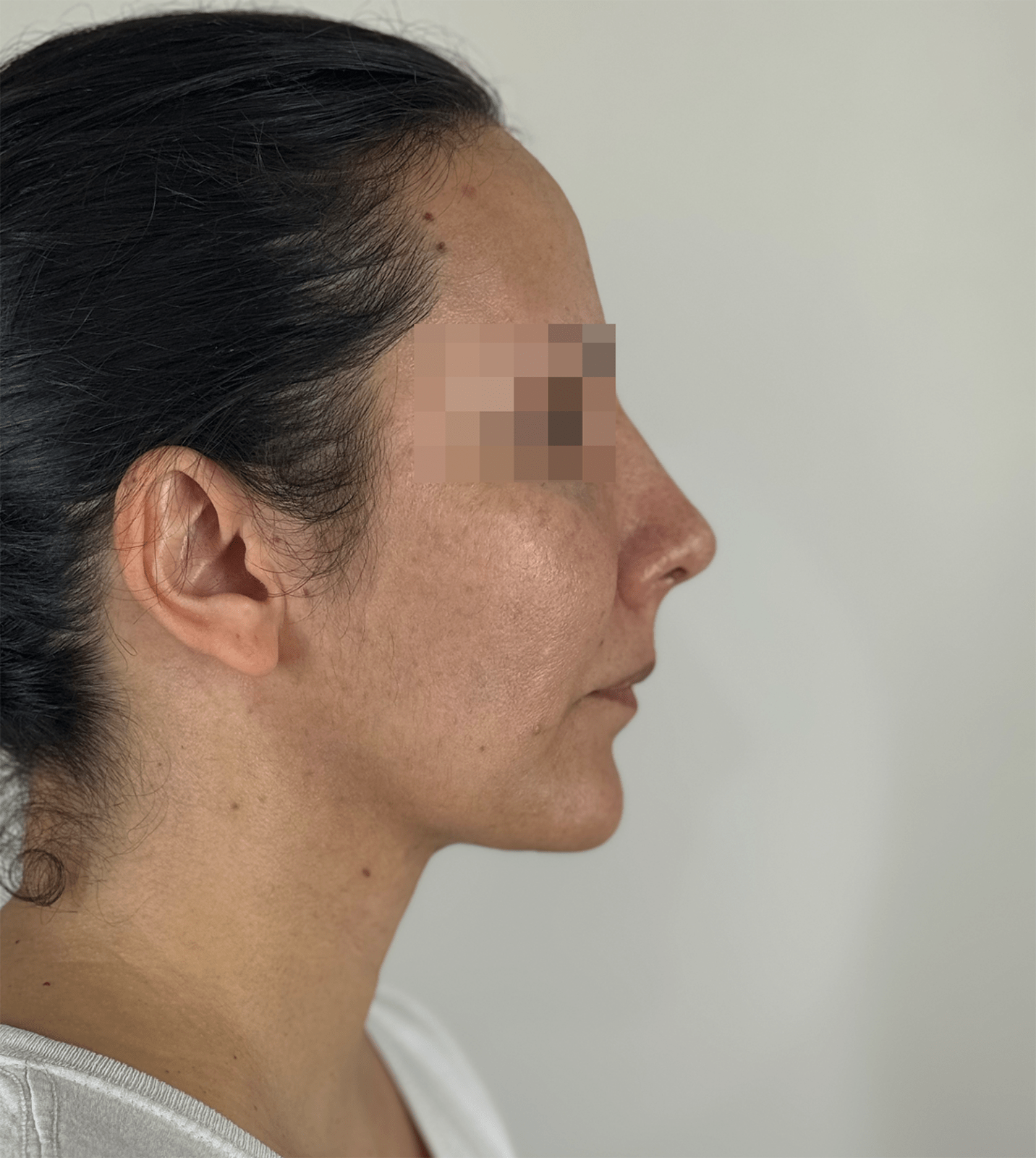 Despues de rinoplastía - caso 1